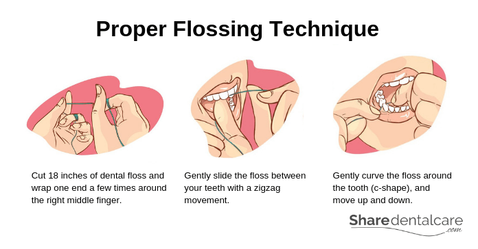 Proper Flossing Technique and Oral Hygiene
