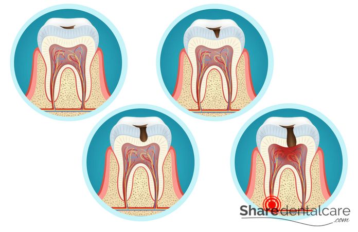 Stages of dental caries