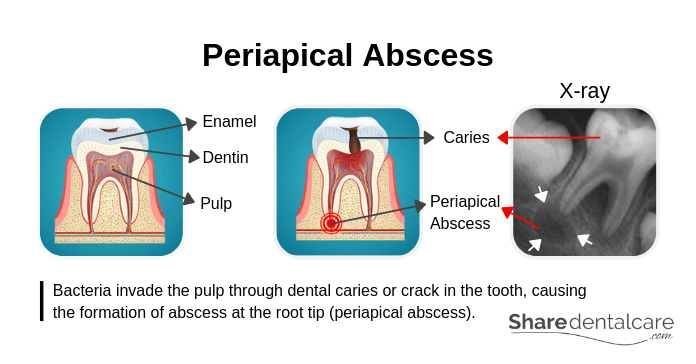 Causes of Periapical Abscess