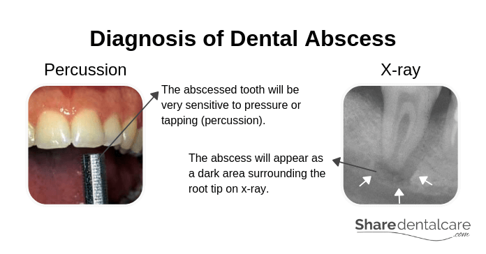 Diagnosis of Dental Abscess