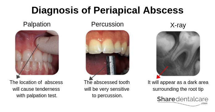 Diagnosis of Periapical abscess