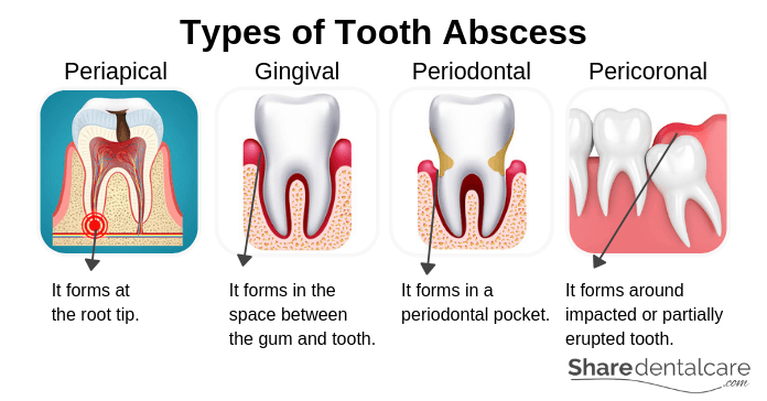 Types of Tooth Abscess