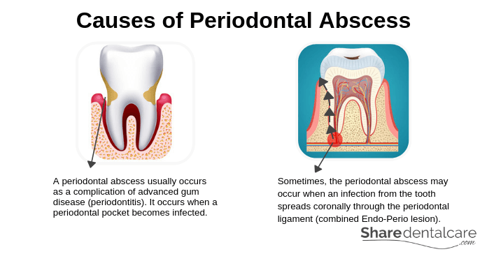 Gingival Abscess Symptoms