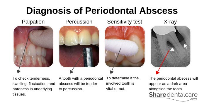 Diagnosis of Periodontal Abscess