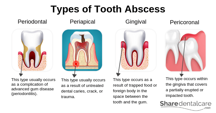 Periodontal Abscess Symptoms Causes Treatment Share Dental Care