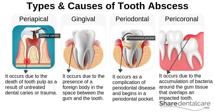 Types of Tooth Abscess and their causes