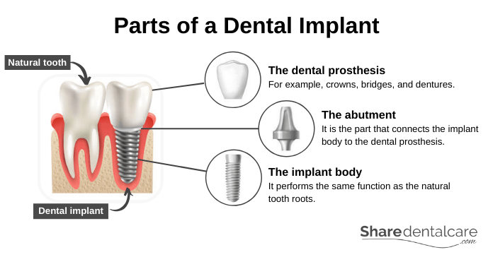 Illustration of dental implant parts