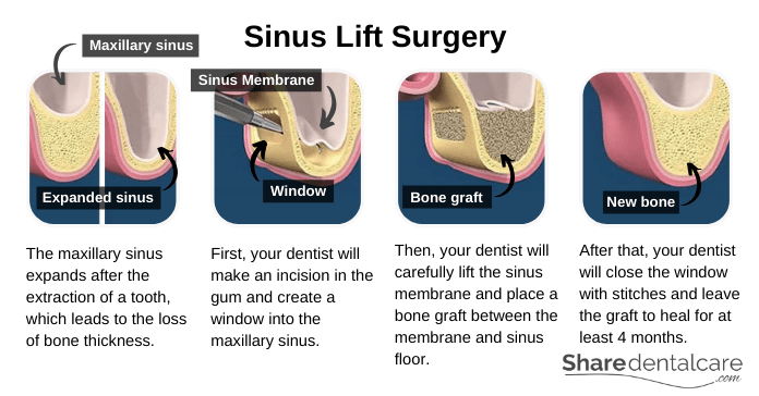 Illustration of sinus lift surgery (sinus augmentation)
