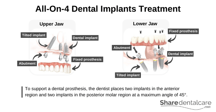 All-on-4 dental implants technique