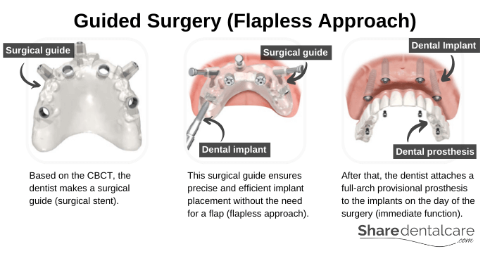 Guided all-on-4 dental implants surgery (flapless approach)