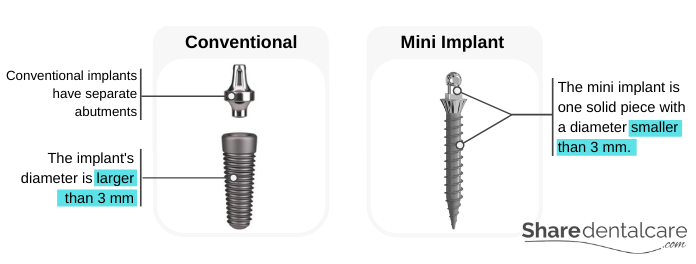 Differences between Conventional Implants and Mini Dental Implants