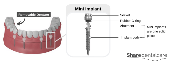 Mini Dental Implants