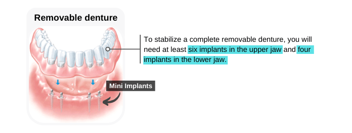 Denture Supported by Mini Dental Implants