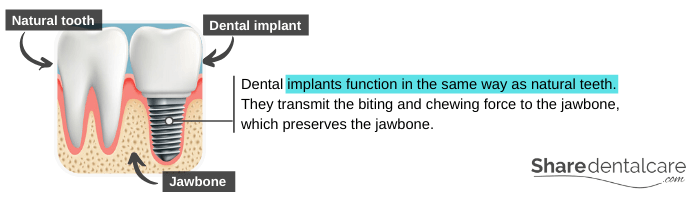 Dental implants function in the same way as natural teeth