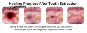 Tooth Extraction Aftercare (Instructions): The Dos & Don’ts