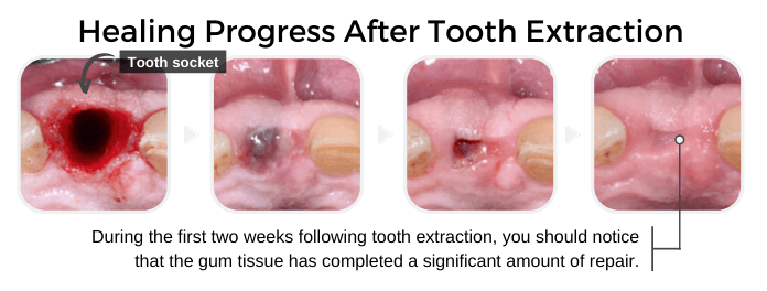 Tooth Extraction Aftercare Instructions The Dos Don ts