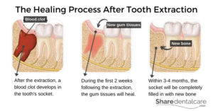 dating chat dos and donts after tooth extraction