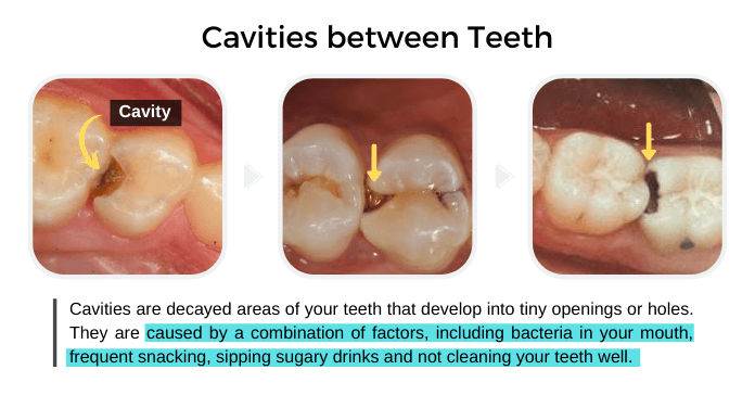 Cavities in between Teeth