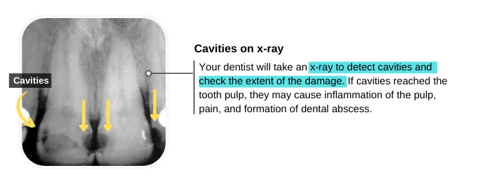 Cavities in Front Teeth on x-ray