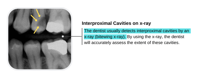 Interproximal Cavities on x-ray