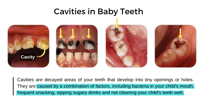 Cavities in Baby Teeth