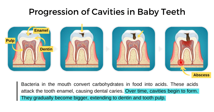 Progression of Cavities