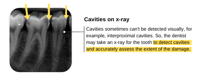 Diagnosis of Cavities (X-ray)