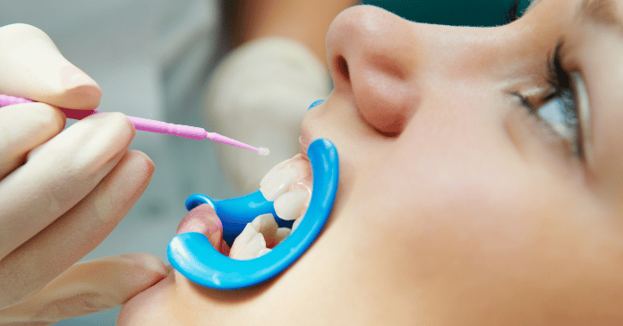 A dentist applying fluoride treatment to a patient's teeth with a specialized tool.