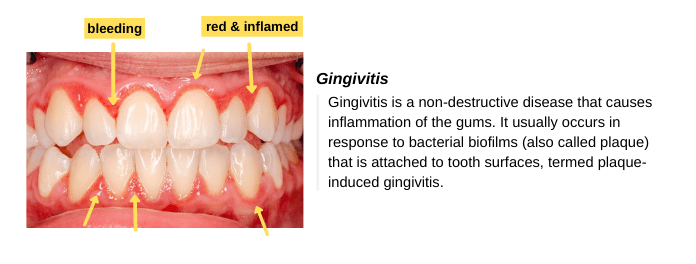 Unhealthy gums (gingivitis) are red or purple in color