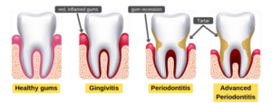 Pregnancy Gingivitis: Treat Swollen Gums during Pregnancy