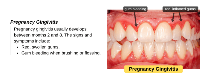 Signs and symptoms of pregnancy gingivitis