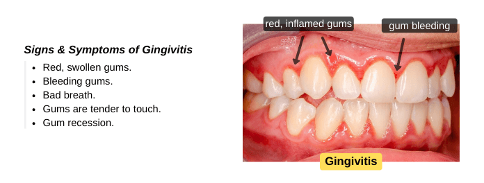 Signs and Symptoms of Gingivitis