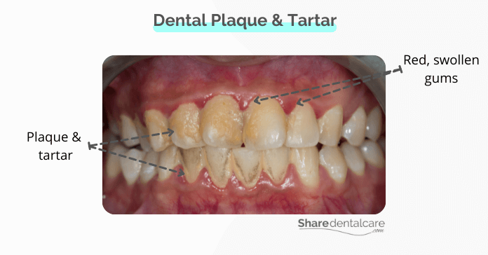 Dental plaque and gums infection