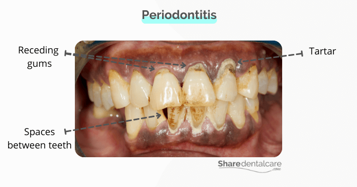 Periodontitis, a severe stage of gum infection