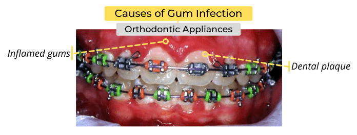 Orthodontic appliances and plaque buildup