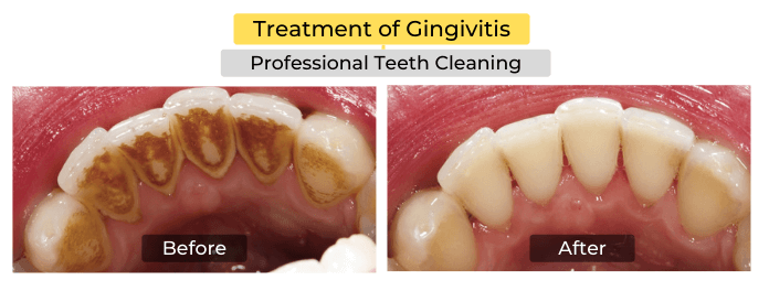 Professional teeth cleaning before and after 