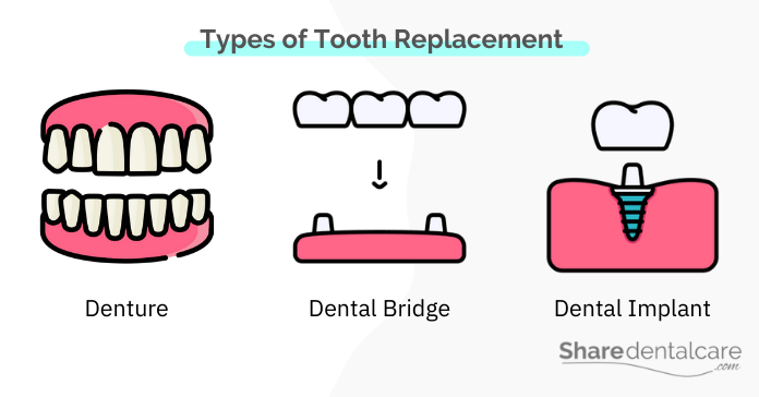 3 Types of Tooth Replacement: dentures, dental bridges, and implants