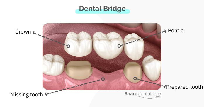 Dental bridges are more stable & durable than dentures