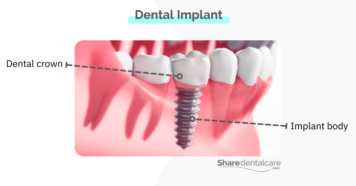 Dental implants are better than other types of tooth replacement