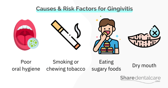 Causes and risk factors for gingivitis