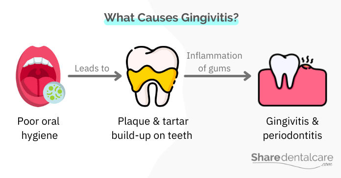 plaque & tartar irritate gums, causing gingivitis
