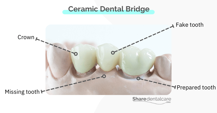 Getting a ceramic fake tooth - dental bridge