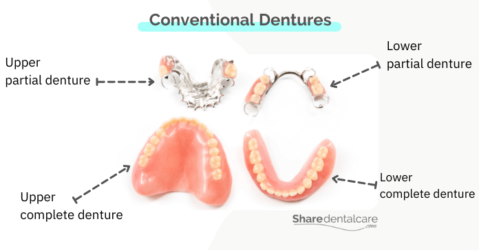 Types of conventional dentures for replacing missing teeth