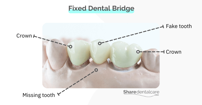Fixed dental bridge