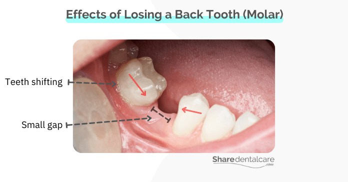 Effects of Losing Back Teeth (Molars)