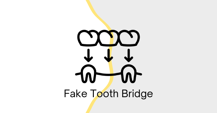 What Is A False Tooth Bridge? , How Much Does a Dental Bridge Cost? – RLMES
