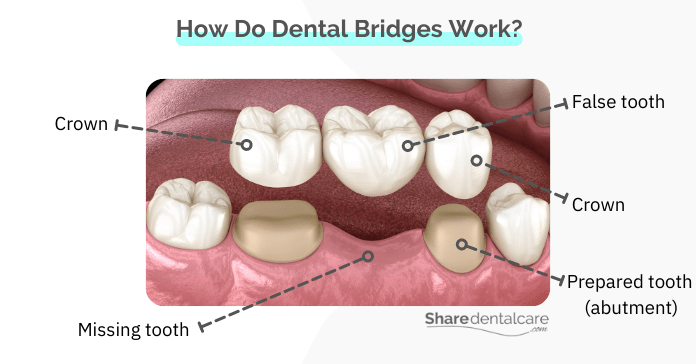 How do dental bridges work?