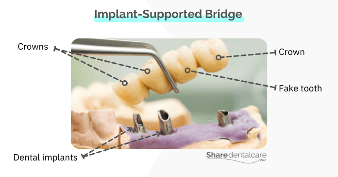 Implant-Supported Bridge