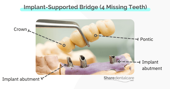 An implant-supported bridge for 4 missing bottom Teeth