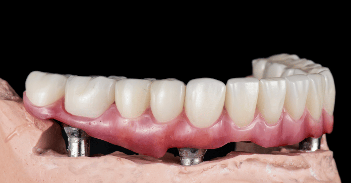 A dental implant-supported denture model with visible implant analogs beneath the artificial teeth.